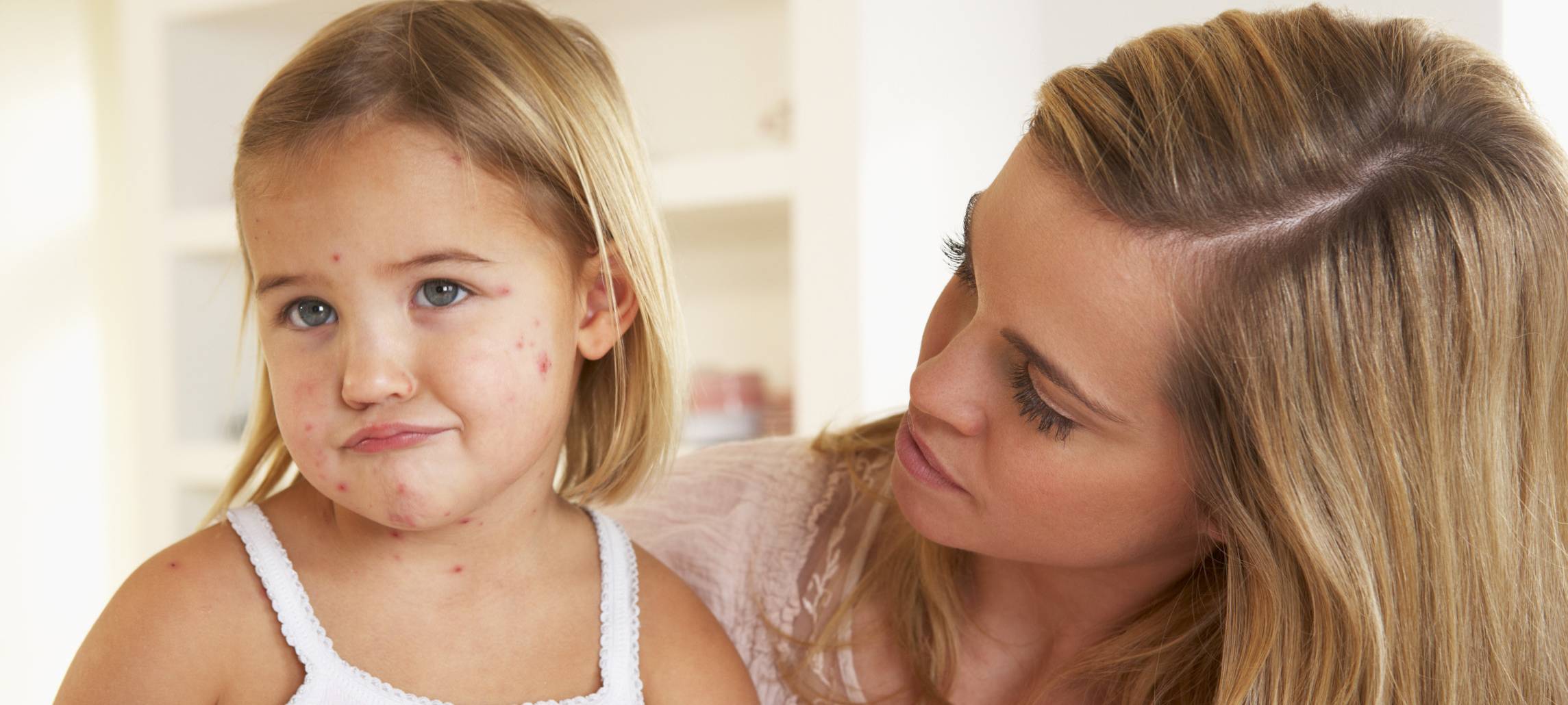 Deutlich weniger Windpocken-Fälle im Kreis Unna