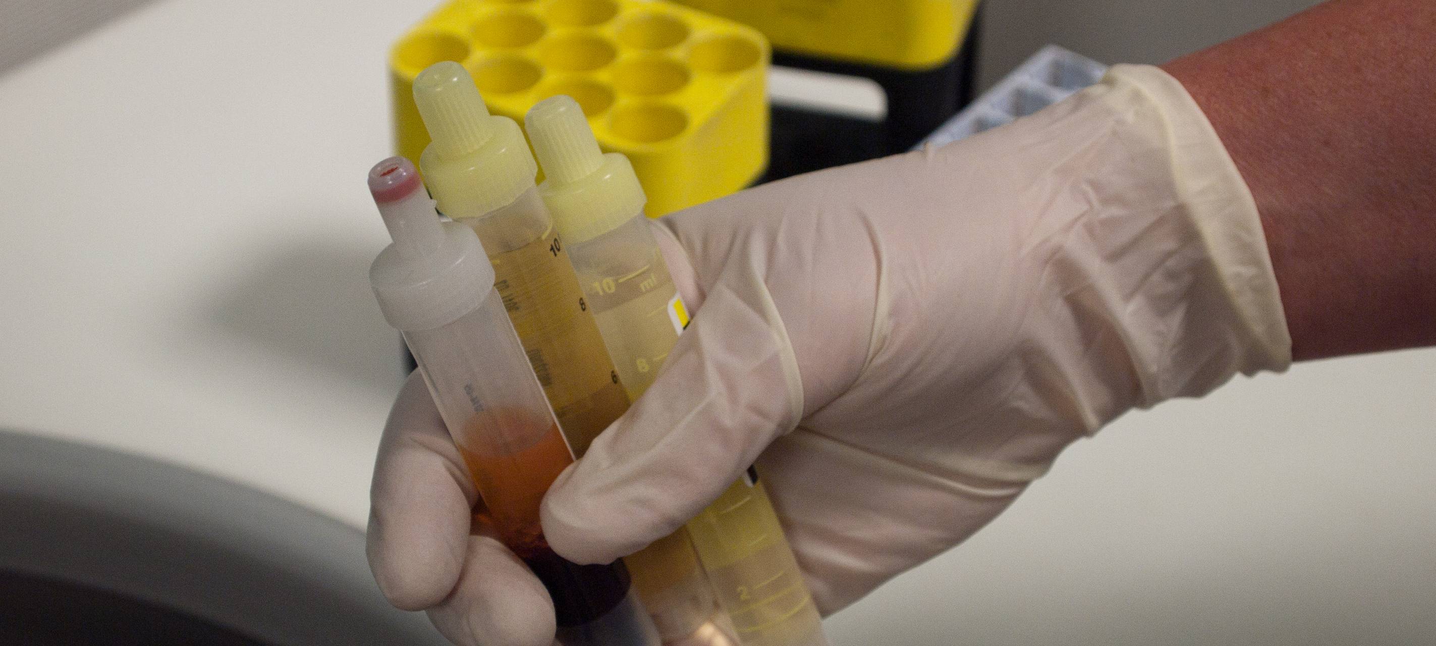 61 Corona-Infizierte im Kreis Unna