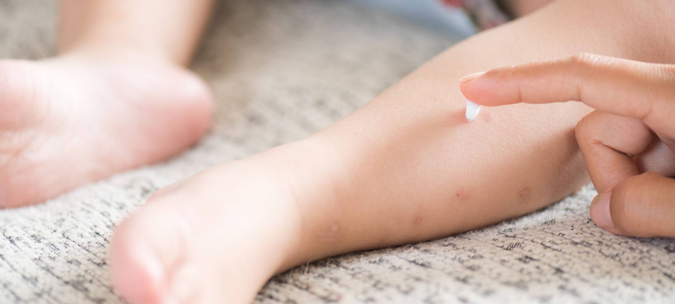 Weniger Windpocken im Kreis Unna