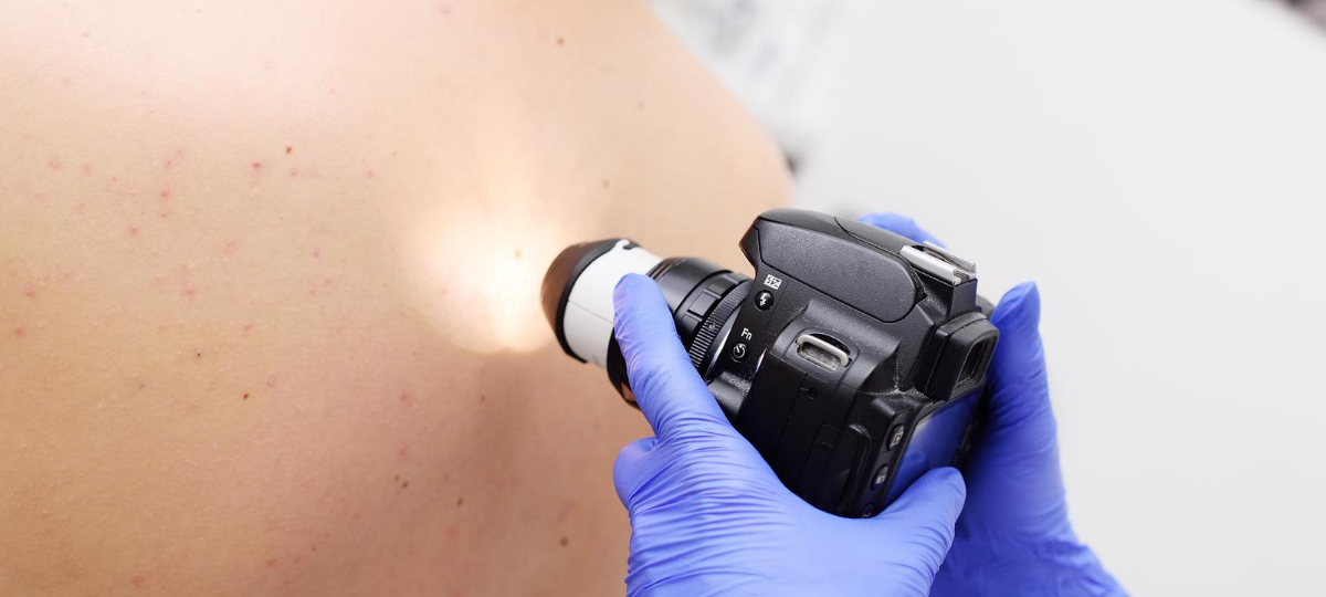 Kreis Unna: Hautkrebs-Vorsorge wird vernachlässigt